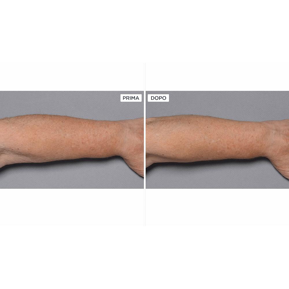 QVC Perricone MD Cold Plasma+Fragile Skin corpo 2pz Shopping Online