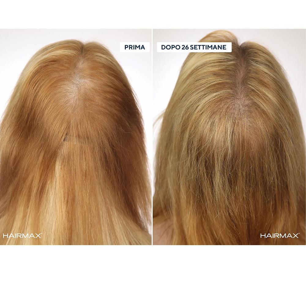 QVC HairMax LaserBand Dispositivo laser crescita capellI Promozione