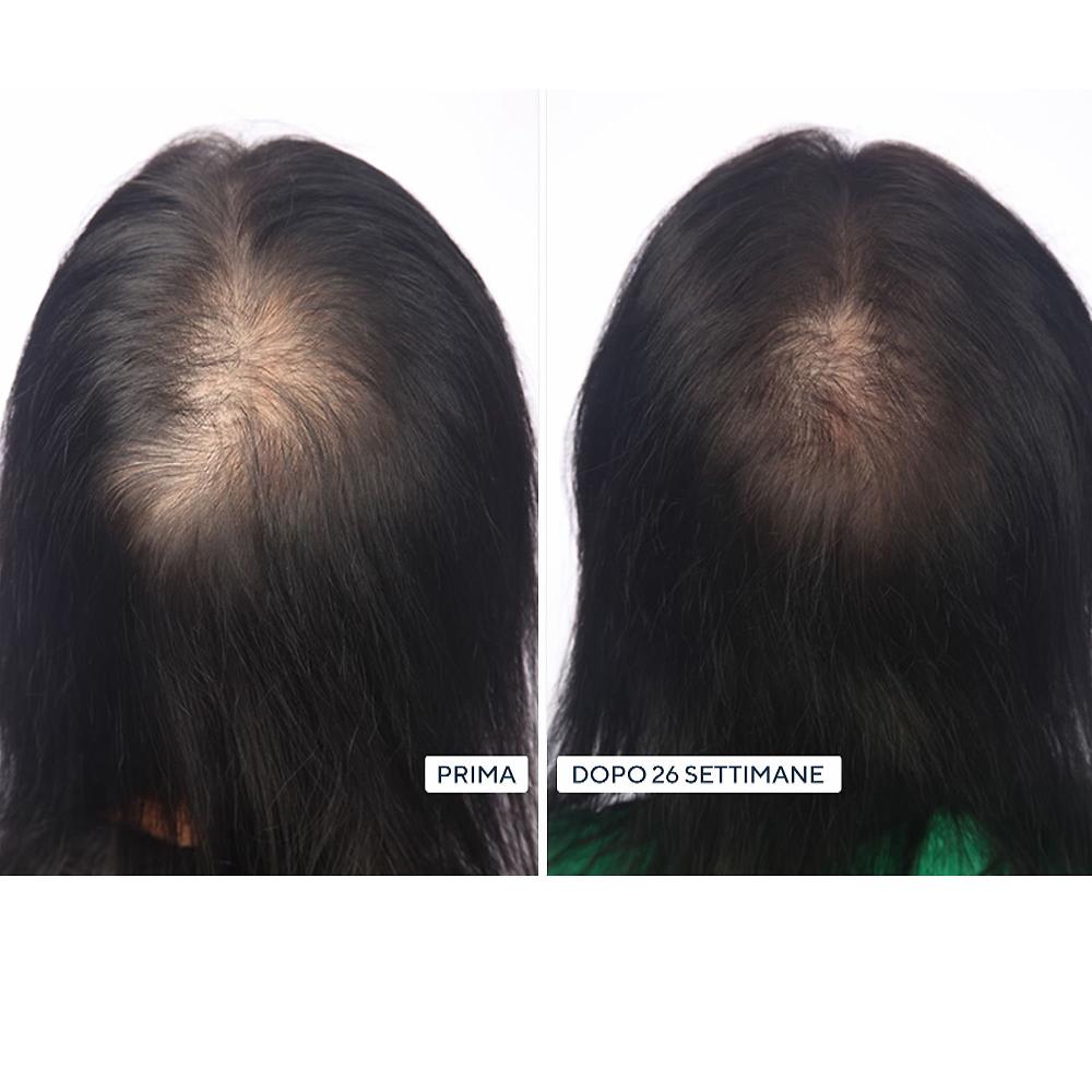 QVC HairMax LaserBand Dispositivo laser crescita capellI Promozione