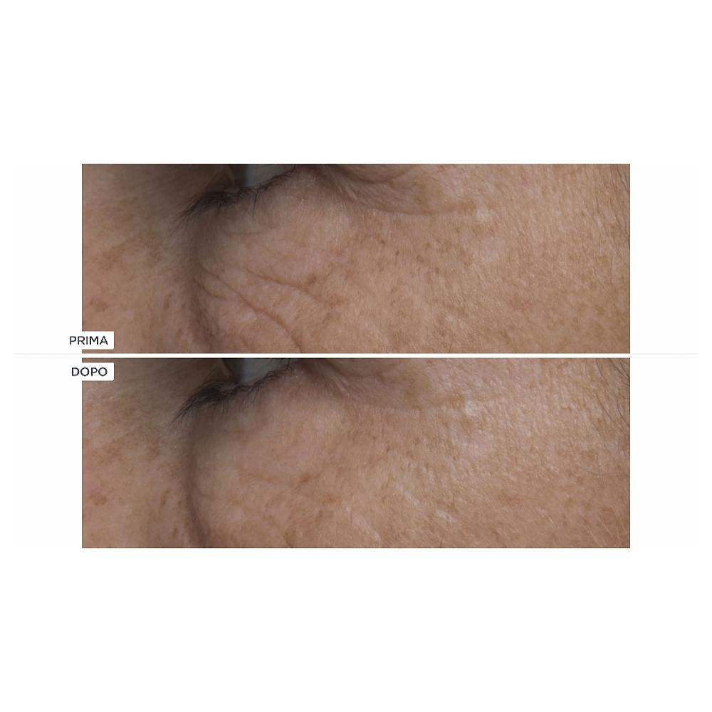 QVC Perricone MD Hypoallergenic e Cold Plasma+ Kit viso occhi labbra Offerte esclusive